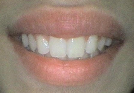 After Invisalign orthodontic treatment