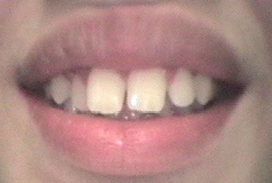 Before Invisalign orthodontic treatment
