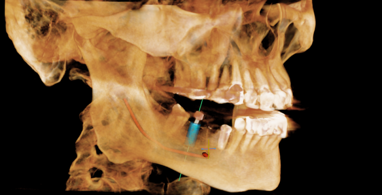 Dental Implant X-Ray